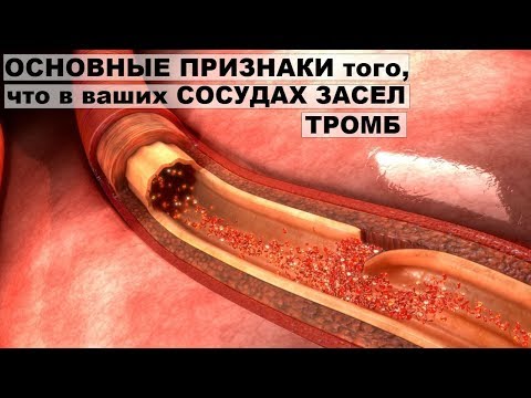 Видео о препарате Пентосан (Пентозан) полисульфат SP 54 (Cystopen) капс. 100мг N30